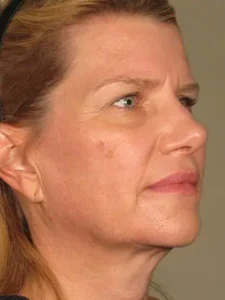 Ultherapy After Treatment by MilfordMD in Richard Buckley, MD