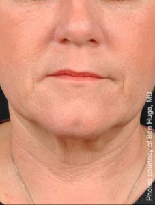 Precisiontx Laser Lipo Neck Lift Treatment by MilfordMD in Richard Buckley, MD