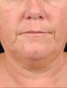 Precisiontx Laser Lipo Neck Lift Treatment by MilfordMD in Richard Buckley, MD