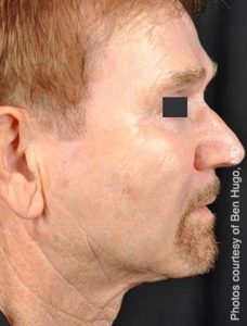 Precisiontx Laser Lipo Neck Lift Treatment by MilfordMD in Richard Buckley, MD