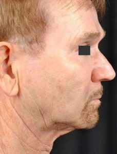 Precisiontx Laser Lipo Neck Lift Treatment by MilfordMD in Richard Buckley, MD