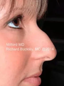 Rhinoplasty Non Surgical Injection Nose By MilFord MD, Richard Buckley MD