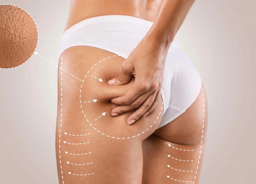 Brazilian Butt Lift by MilfordMD Cosmetic Dermatology Surgery Laser Center in Milford