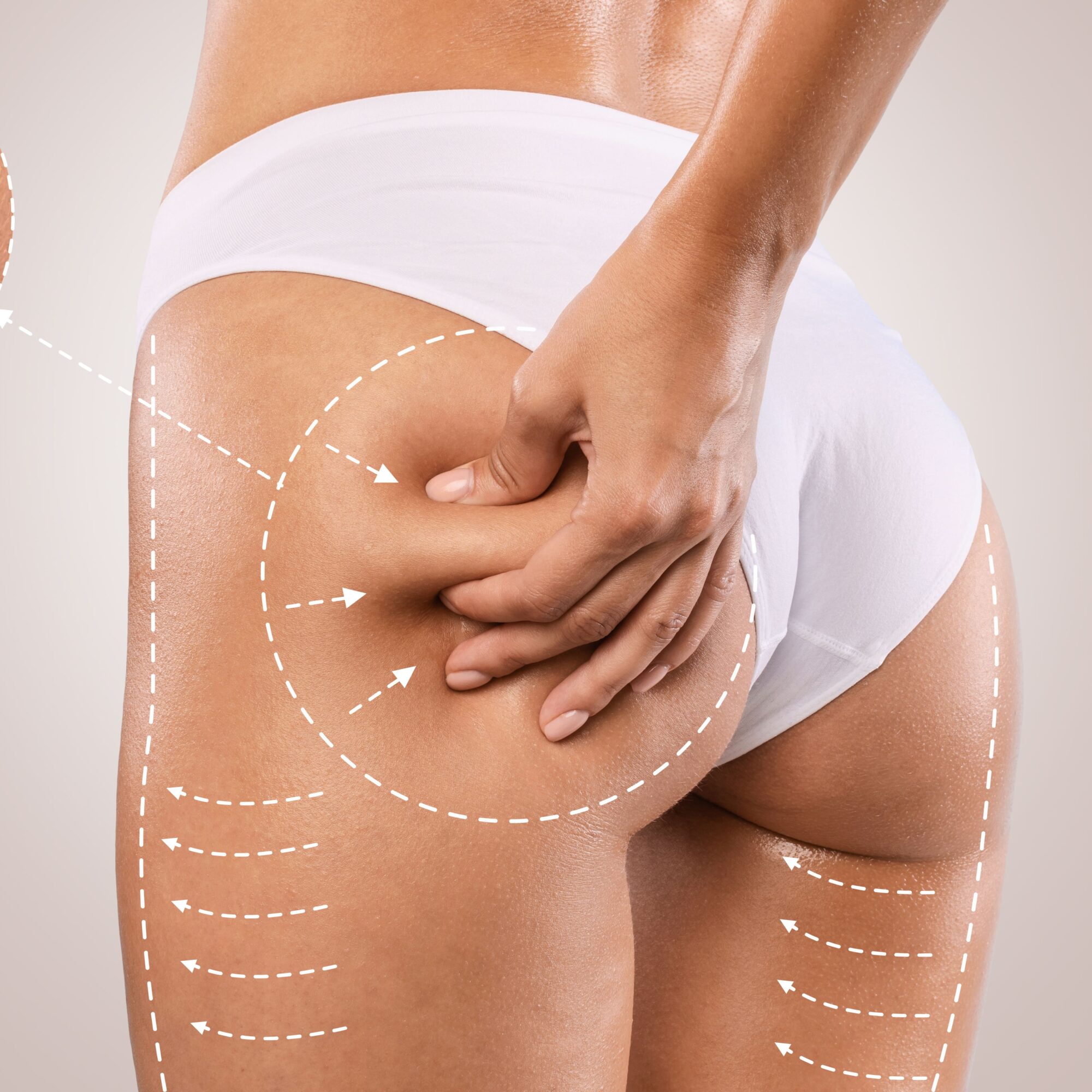 Brazilian Butt Lift by MilfordMD Cosmetic Dermatology Surgery & Laser Center in Milford PA