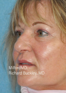 Blepharoplasty–Lower Seven L After Milford PA MilfordMD