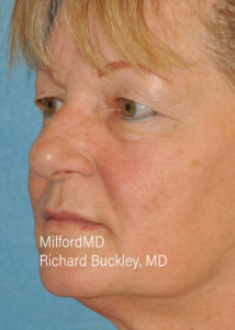 Blepharoplasty–Lower Seven L Before Milford PA MilfordMD