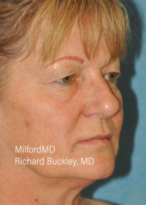 Blepharoplasty–Lower Seven R Before Milford PA MilfordMD