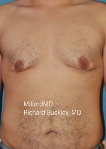 gynecomastia-treatments Front After by MilfordMD in Richard Buckley, MD