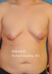 gynecomastia-treatments Front Before by MilfordMD in Richard Buckley, MD