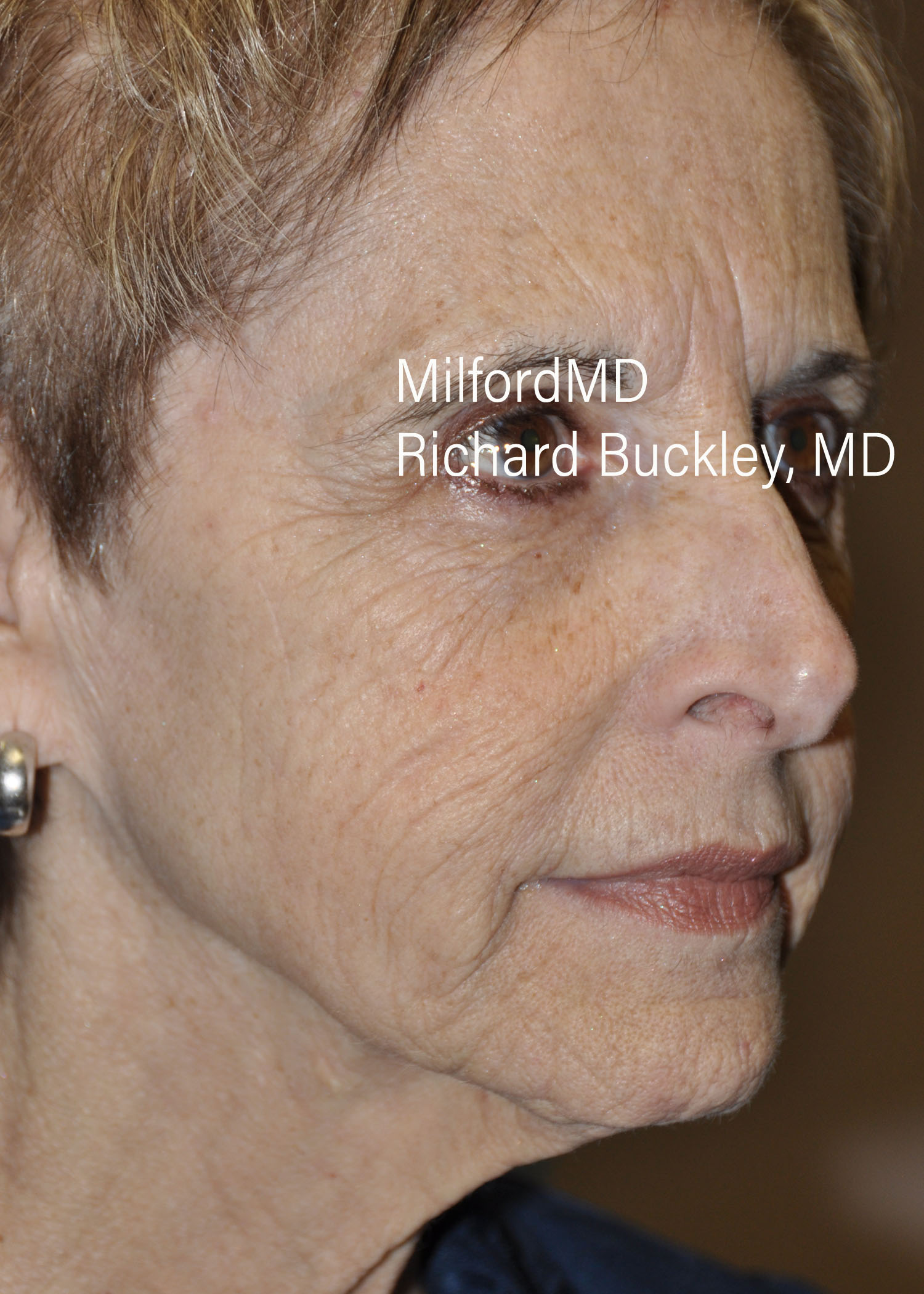 Before: Fat Transfer to Face (AFT)- Case #36111