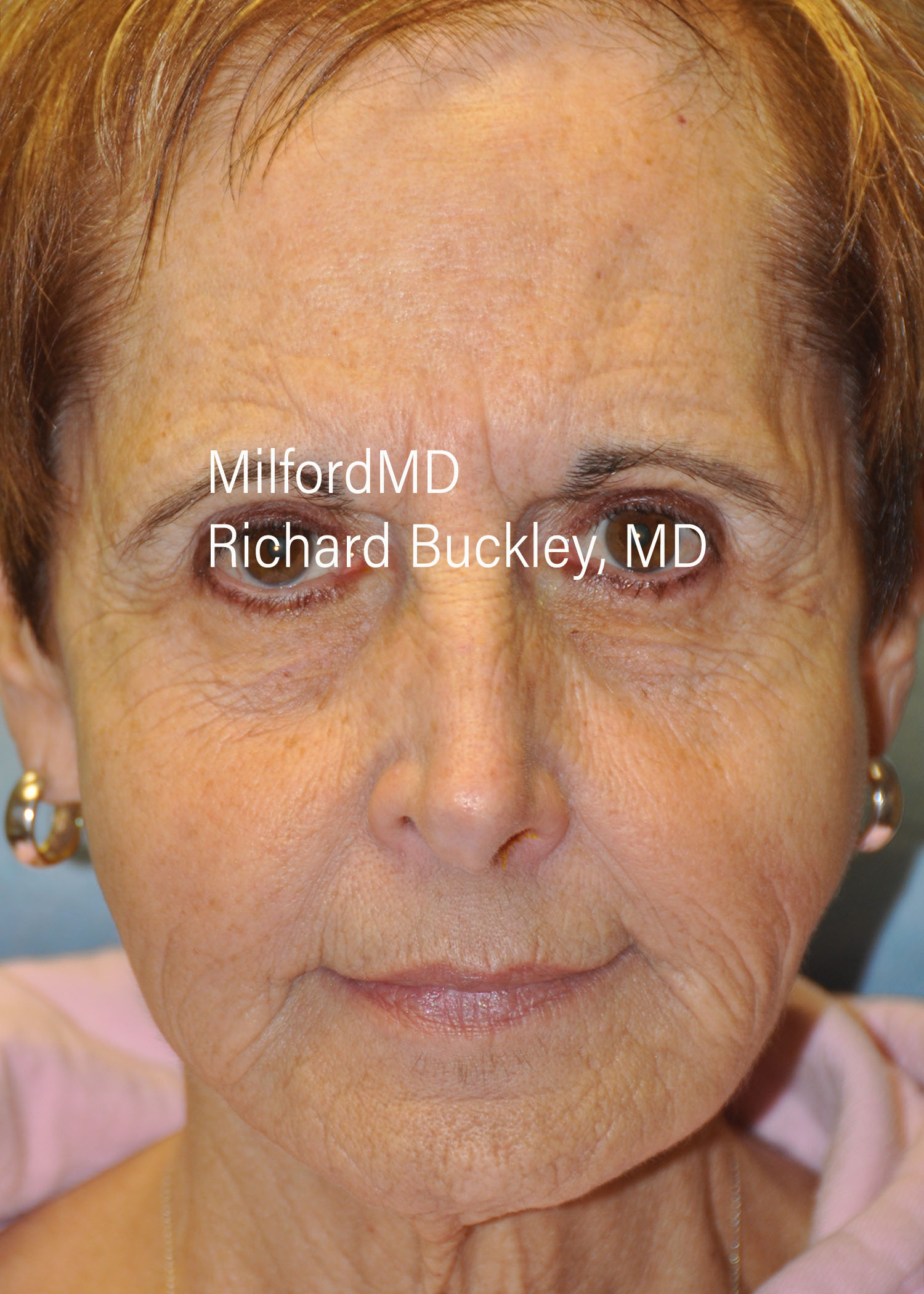 After: Fat Transfer to Face (AFT)- Case #36111