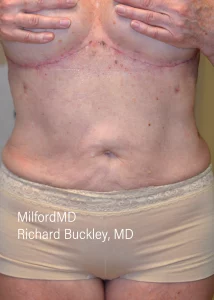 Abdominoplasty Reverse Two Front After Milford PA MilfordMD