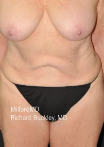 Abdominoplasty Reverse Two Front Before Milford PA MilfordMD