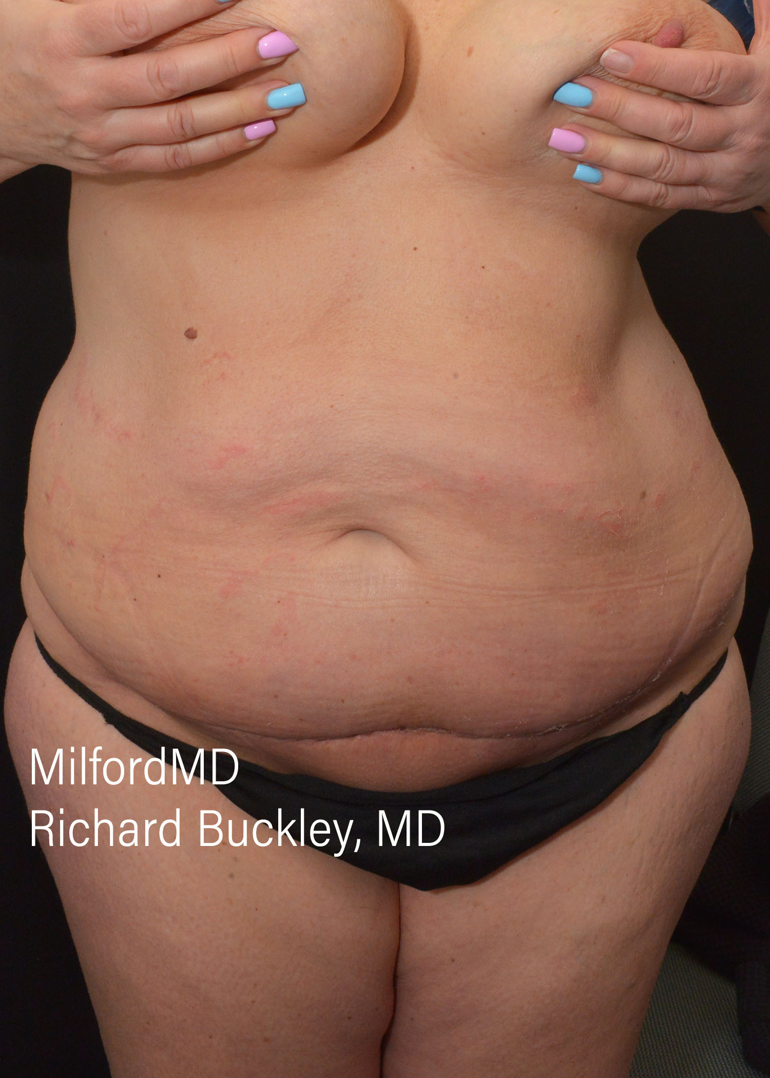Reverse Abdominoplasty Before and After Photos,Reverse Abdominoplasty,Reverse Abdominoplasty Before and After, Abdominoplasty – Reverse