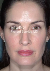 botox-cosmetic-Front-After by MilfordMD in Richard Buckley, MD