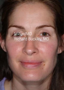 botox-cosmetic-Front-Before by MilfordMD in Richard Buckley, MD