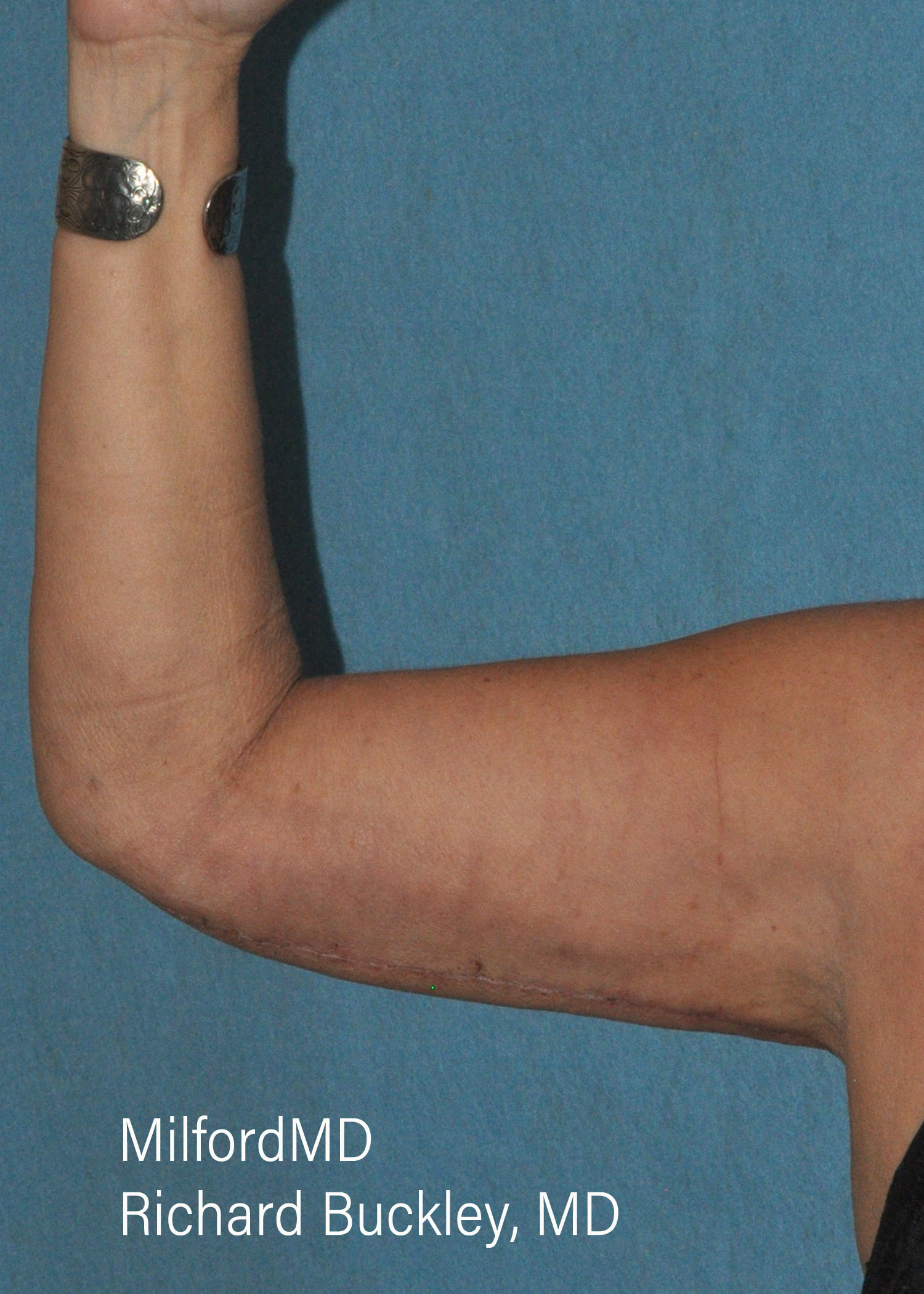 Before & After Photos Brachioplasty (Arm Lift),Brachioplasty Arm Lift near me,Brachioplasty near me, Brachioplasty (Arm Lift) Procedures