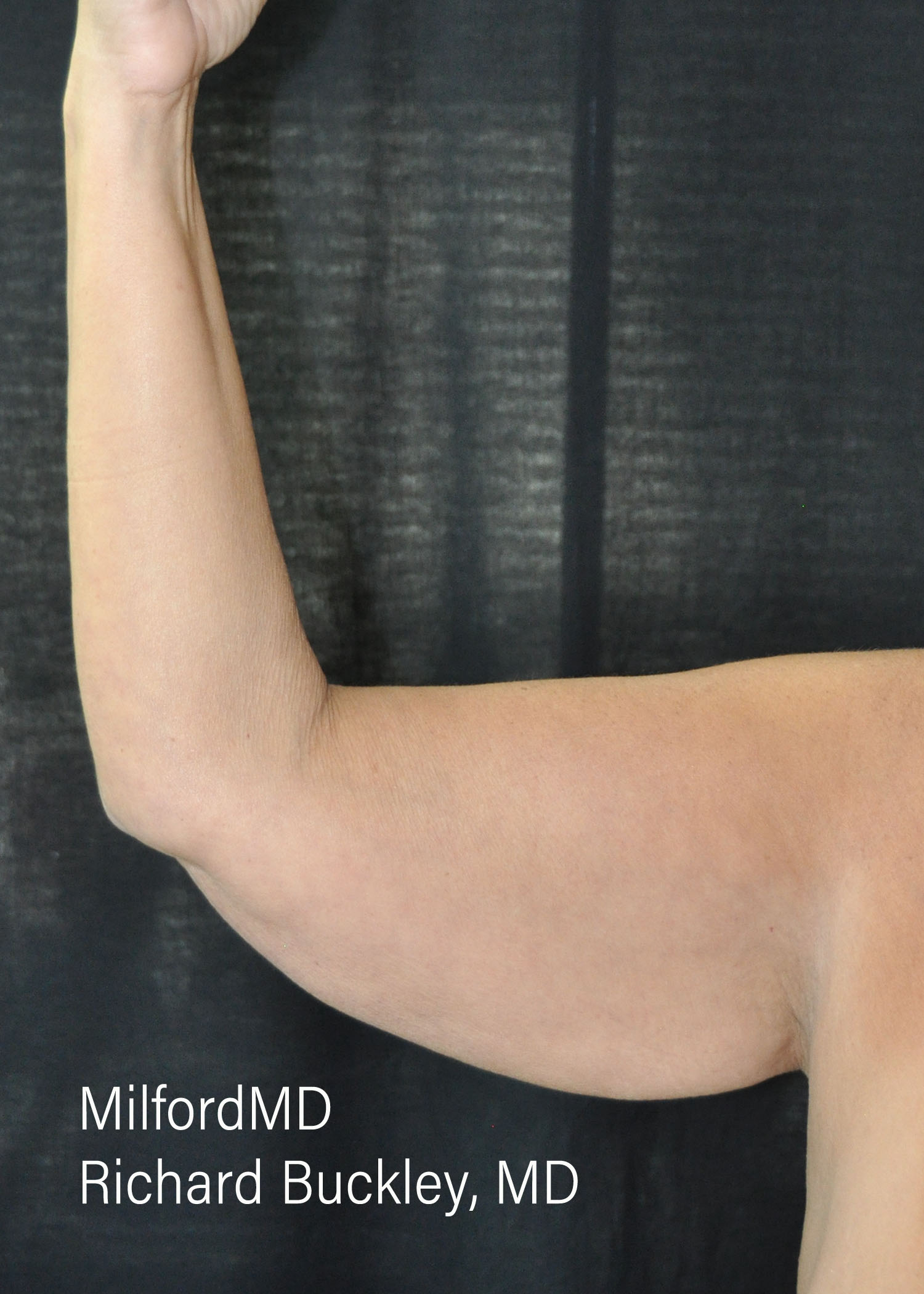 Before: Brachioplasty (Arm Lift) – Case #36114