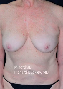 Breast Reduction-1-Front After by MilfordMD in Richard Buckley, MD