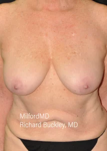 Breast Reduction-1-Front Before by MilfordMD in Richard Buckley, MD