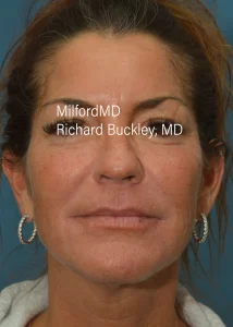 Facelift Nonsurgical After Photo