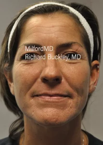 Facelift Nonsurgical Before Photo