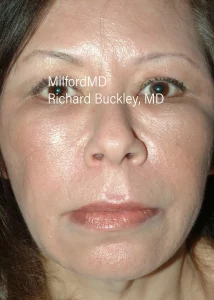 Facelift Surgical Front After Photo