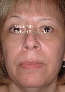 Facelift Surgical Front Before Photo