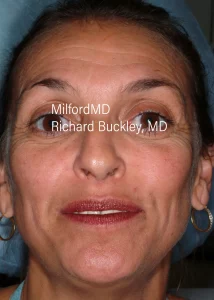 Facelift Nonsurgical Before Photo