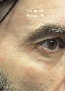 Facial Rosacea Two After Milford PA by MilfordMD