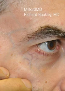 Facial Rosacea Two before Milford PA by MilfordMD