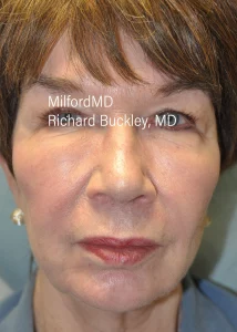 Fat-Transfer-To-Face-AFT-Six-After-by MilfordMD in Richard Buckley, MD