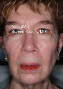 Fat-Transfer-To-Face-AFT-Six-Before-by MilfordMD in Richard Buckley, MD