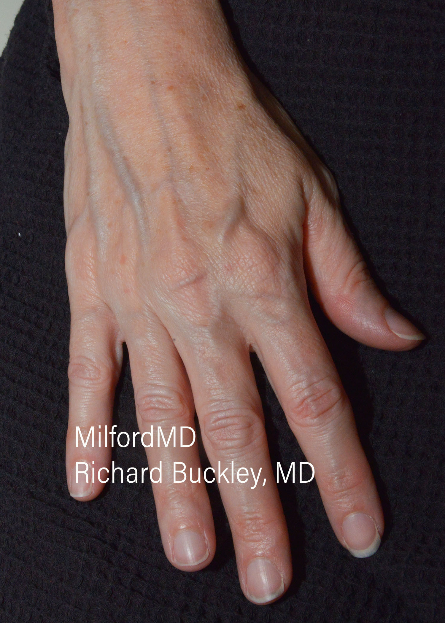 Before: Fat Transfer Hands – Case #35921