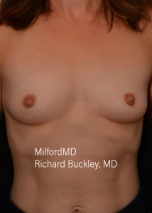 Inverted Nipple Repair after by milfordmd