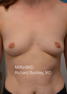 Inverted Nipple Repair before by milfordmd