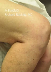 leg-vein1 by MilfordMD in Richard E. Buckley, MD