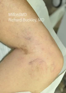 leg-vein1 by MilfordMD in Richard E. Buckley, MD