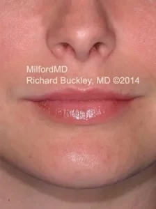 Lip Augmentation Filler By MilFord MD - Richard Buckley MD