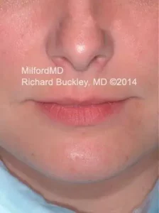 Lip Augmentation Filler By MilFord MD - Richard Buckley MD