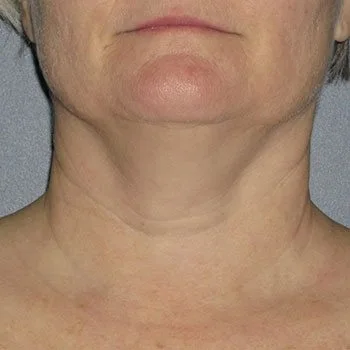 before-treatment-img