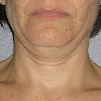 before-treatment-img