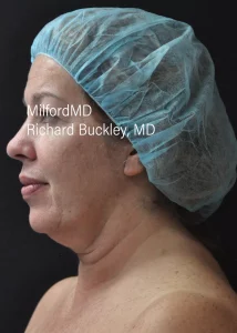 Neck Lift Left Before photo