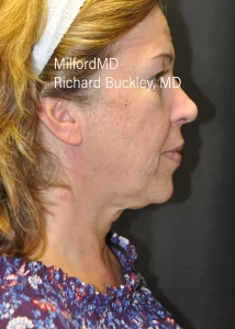 Patient Neck Lift Right After Photos in Milford, PA | MilfordMD Cosmetic Dermatology Surgery & Laser Center