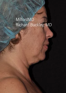 Patient Neck Lift Right Before Photos in Milford, PA | MilfordMD Cosmetic Dermatology Surgery & Laser Center