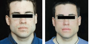 Omnilux Light Therapy By MilfordMD
