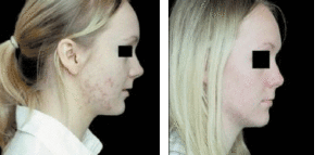 Omnilux Light Therapy By MilfordMD