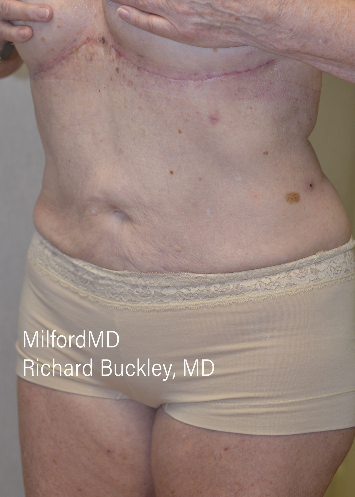 After: AUGMENTATION –REVERSE– CASE #62603