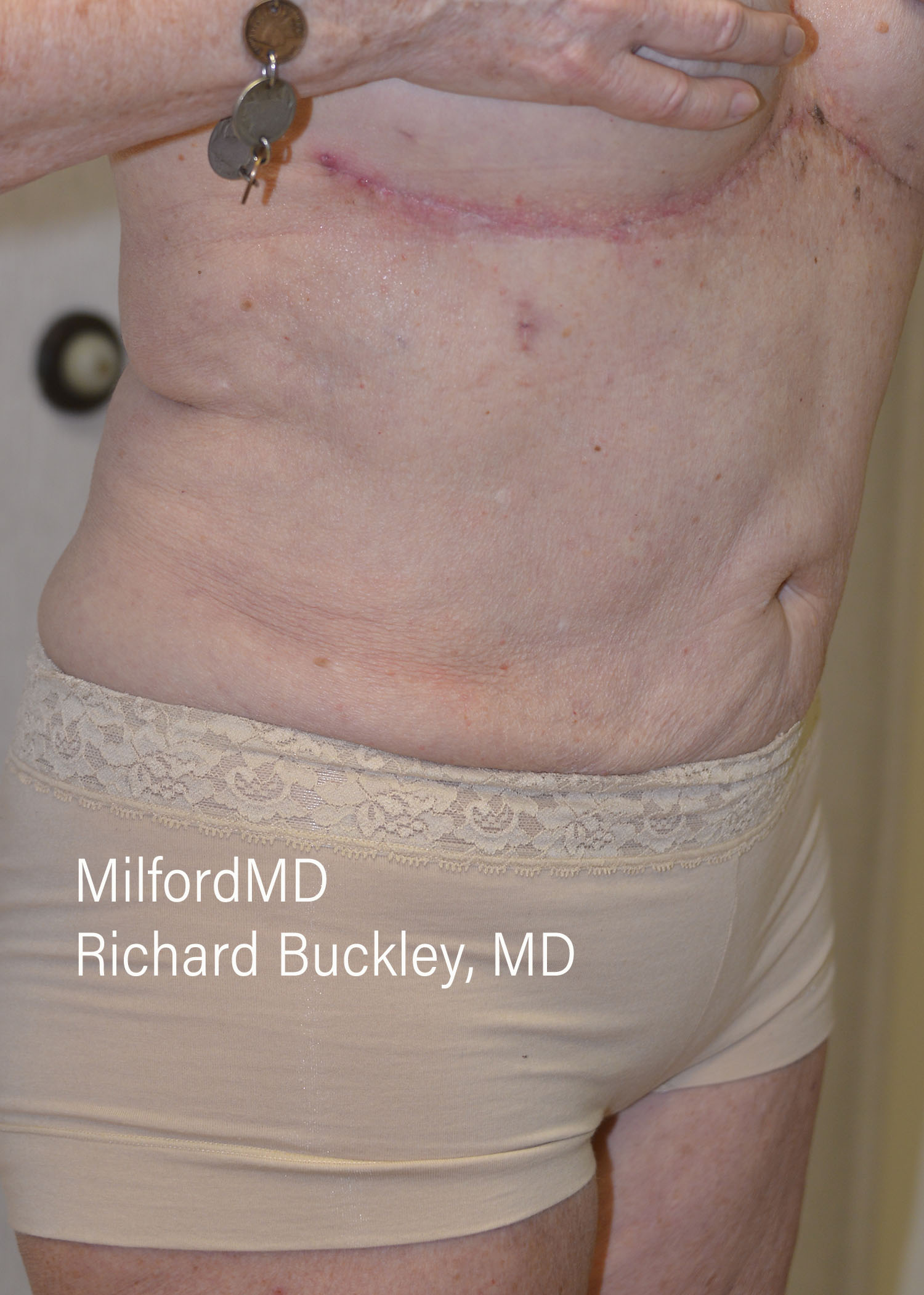 After: AUGMENTATION –REVERSE– CASE #62603