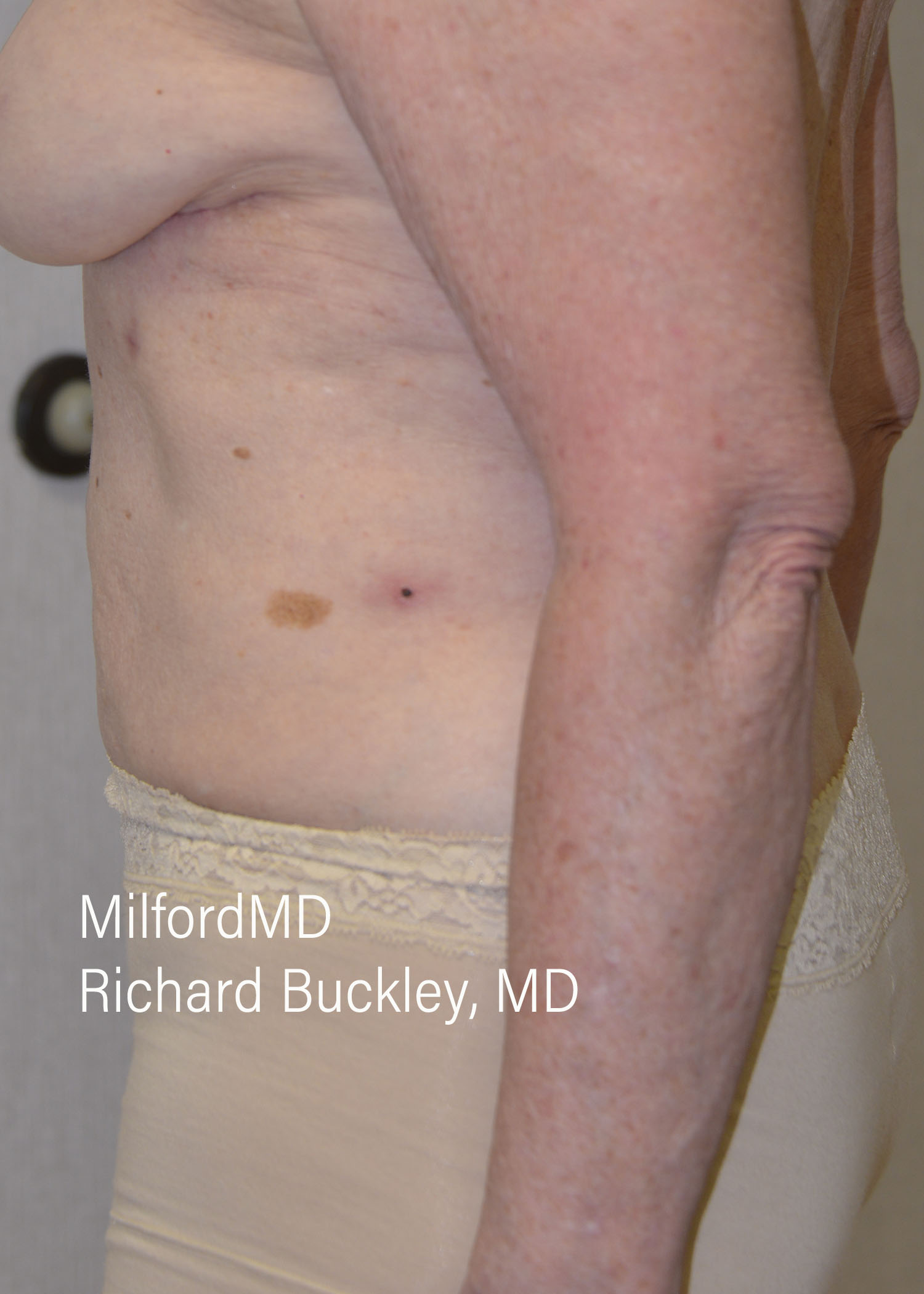 After: AUGMENTATION –REVERSE– CASE #62603